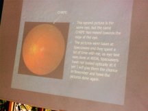 John's eye showing CHRPE whether left or right not sure but taken at Specsavers. CHRPE is not dangerous and even called Bear Trails by Mick's Optician. Main point of John's talk was to raise awareness especiall when benifical to those with no family history of bowel problems.